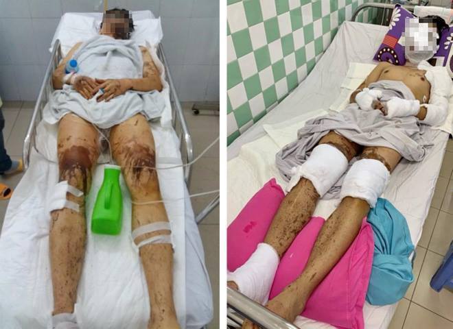 Việt kiều Canada bị tạt axit, cắt gân chân trong đêm